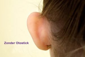 oren zonder oorcorrectie doormiddel van flapoorstickers